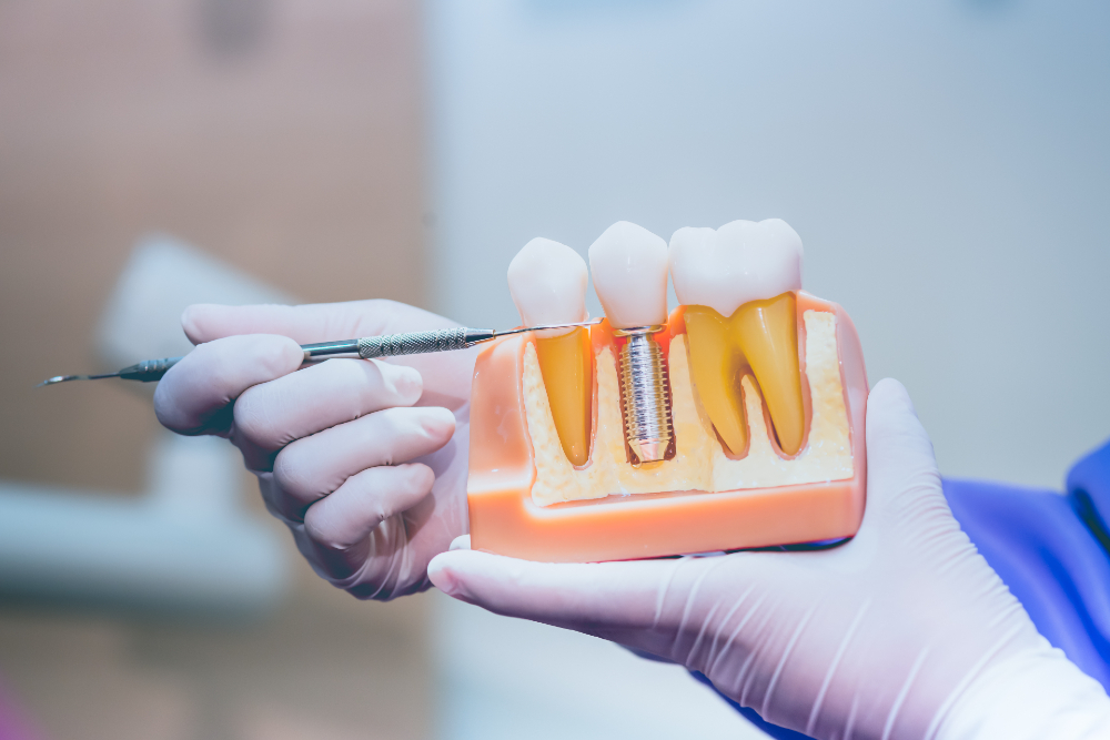 What Are The Pros And Cons Of Dental Implants Rockland Dental Specialists