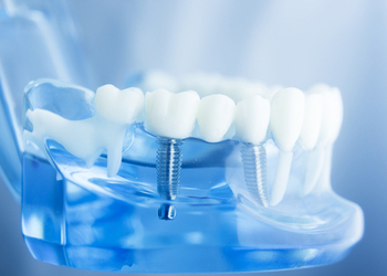 What are Dental Implants